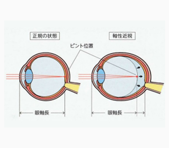 子どもの近視の進行を抑える大切な理由