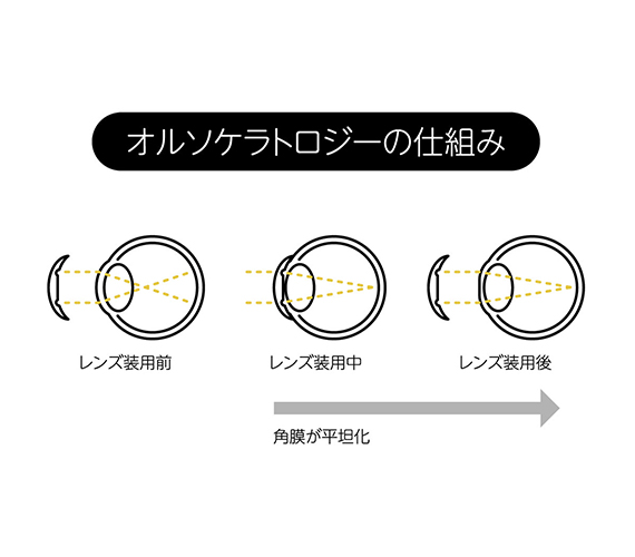 オルソケラトロジーで使用するレンズについて